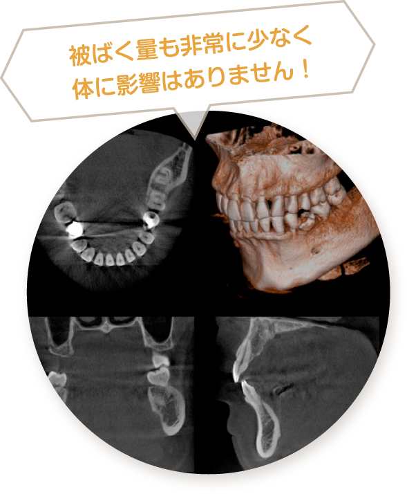 大泉学園駅・﻿にじいろマイクロスコープセラミック歯科医院・被ばく量も非常に少なく体に影響はありません！