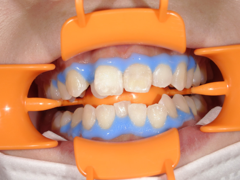 歯茎保護で専用ジェルを塗布