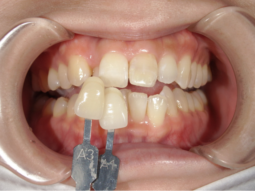 歯の色味表で変化を確認